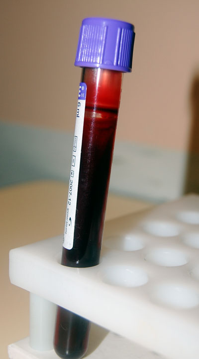 blood-test-result